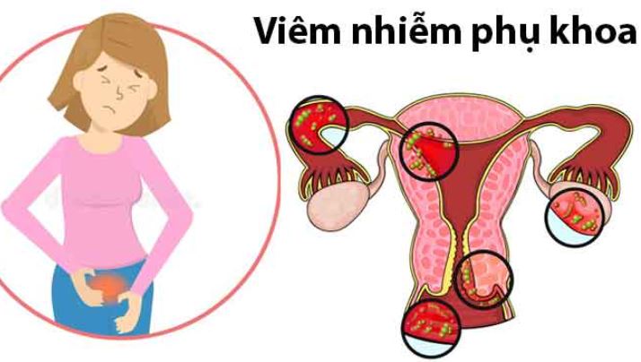 dấu hiệu viêm nhiễm phụ khoa ở nữ giới
