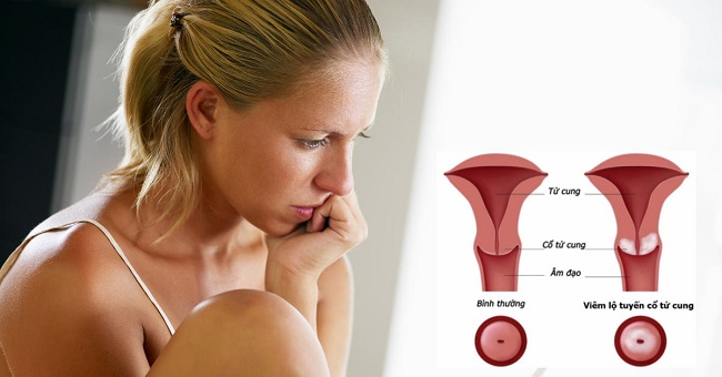 phương pháp chữa viêm lộ tuyến cổ tử cung