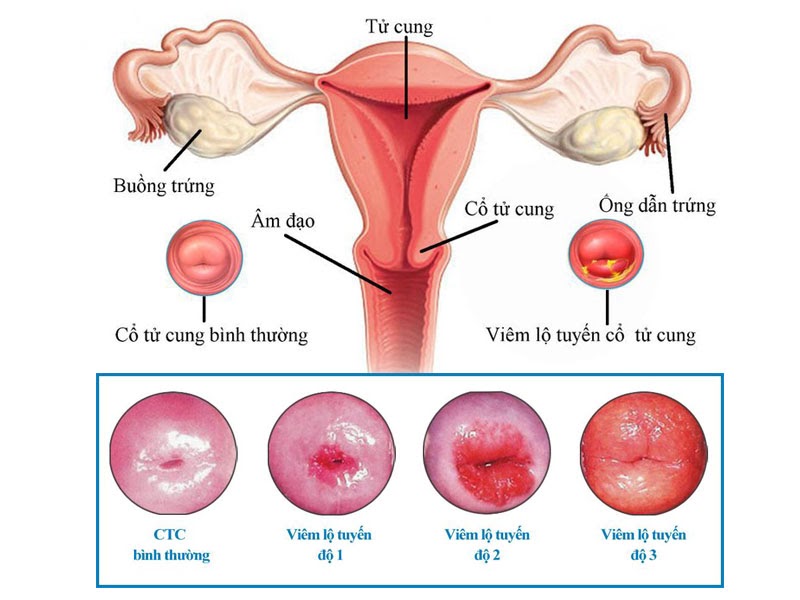 Các cấp độ viêm lộ tuyến cổ tử cung ở nữ giới cần biết 