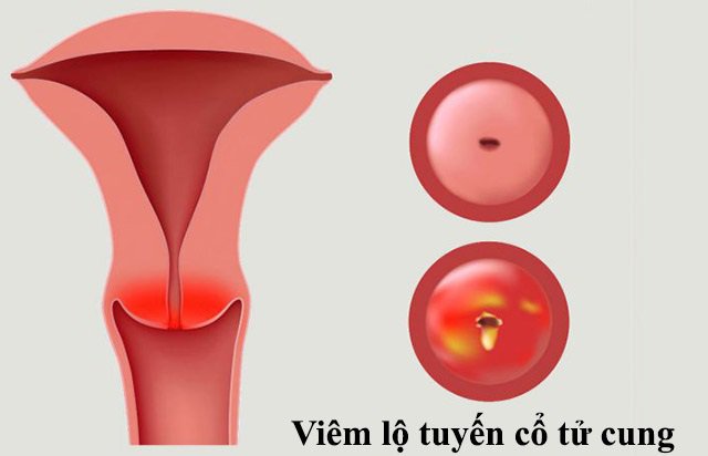 Viêm lộ tuyến cổ tử cung có nguy hiểm không? Bác sĩ giải đáp