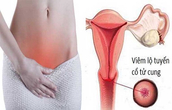 Top 05 nguyên nhân viêm lộ tuyến cổ tử cung phổ biến