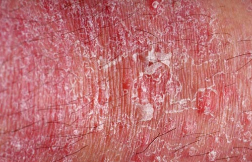 04 nguyên nhân khiến dương vật bị ngứa và lột da